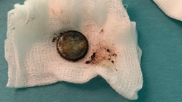 Niña de 2 años se tragó una pila que destruyó su esófago en sólo media hora